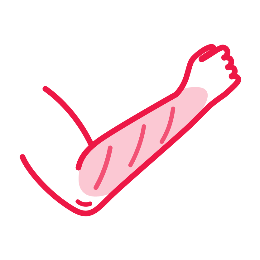 An icon of sunburn on an arm.