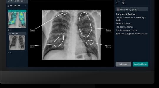 The image shows a chest X-Ray of a pair of lungs on a screen