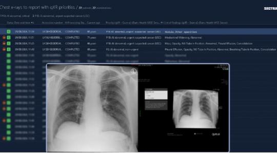Am image of a chest X-ray on a screen.