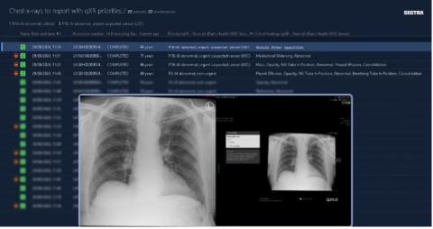Am image of a chest X-ray on a screen.