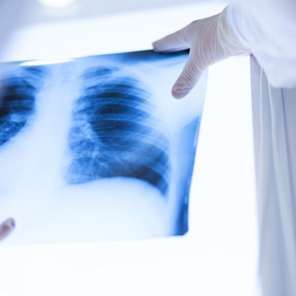 X-ray of chest